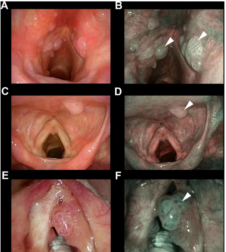 Fig. 3    Endoscopic pictures of three representative cases (a, b; c, d; and e, f) of recurrent laryngeal papillomatosis correctly identified detecting  wide angle IPCLs (arrowheads in all panels) evaluating the NBI endoscopic appearance (b, d, f)