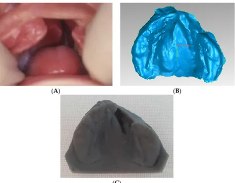 Figure  1.  Unilateral  cleft  lip  and palate  (UCLP)  patient (A)  clinical  picture  and  corresponding (B)  digital and (C) resin printed models