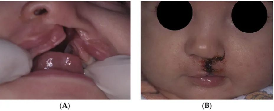 Figure 4. UCLP patient shown in Figure 1 during (A) the final stages of PSOT and (B) after upper lip  surgery