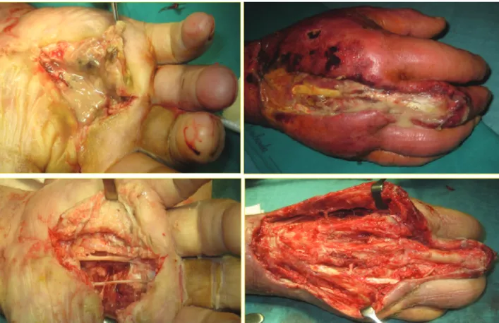Figure 5. Intraoperative findings during the second debridement surgery and excision of the extensor and flexor apparati of the third ray