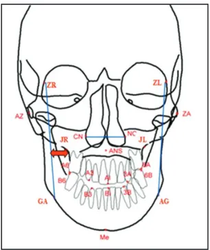 Figure 4.fronto-facial line and the zygomatic point itself (JR 