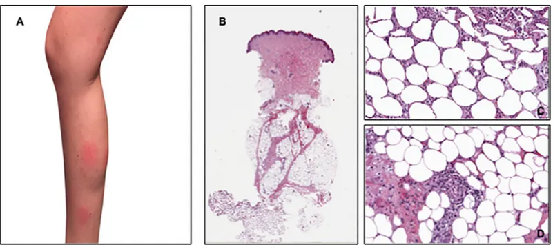 Fig 1. Clinical presentation of the skin eruptions and histopathological findings in one patient