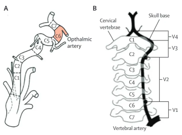 Figure 1: Anatomy of (A) carotid and (B) vertebral arteries, delineating  cervical and intracranial segments