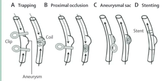Figure 4: Four types of surgical and endovascular treatments