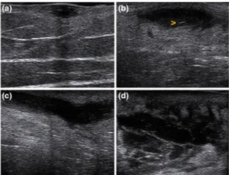 Figure 3 Results: clinical and US HS-PGA scores of 434 HS patients.