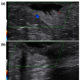 Figure 5 Ultrasound aspect of a ﬁstolous tract at baseline (a) and after 3 months of treatment with systemic clindamycin (b).Figure 4 Ultrasound aspect of a ﬂuid collection at baseline (a)and after 1 month of treatment with adalimumab (b).