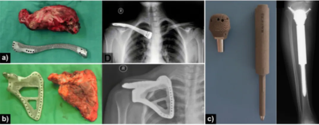 Fig. 2. Examples of AM patient speci ﬁc implants used for reconstruction of resected bone tumours and follow-up x-ray ﬁlms showing placement, speciﬁcally a)