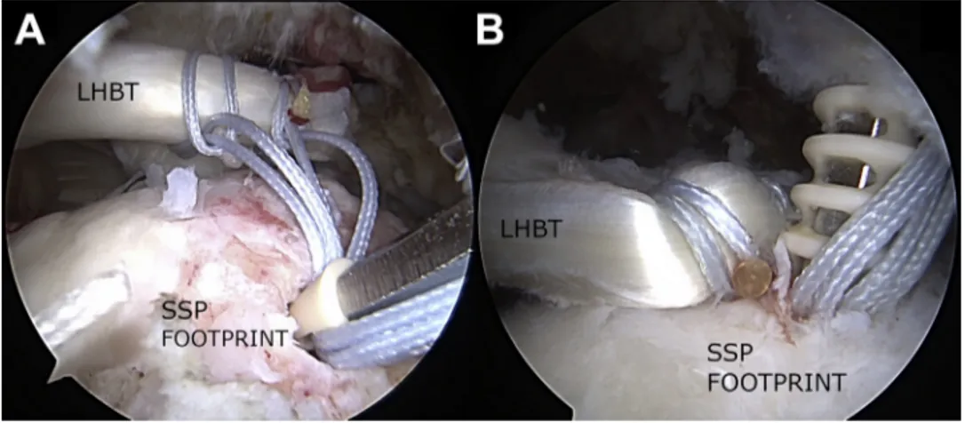 Fig 5. Arthroscopic view (sub- (sub-acromial space) through posterior portal of right shoulder with  pa-tient in beach-chair position