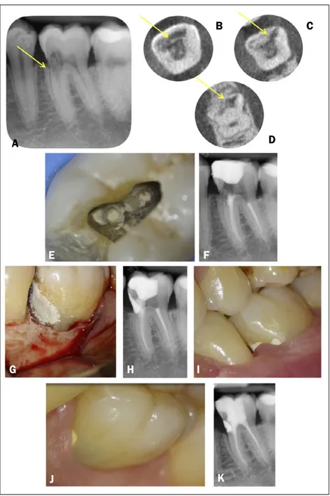 Figure 6 (video 5).  ECR case 5. A) Preoperative radiograph of a 3.6 showed ECR (yellow arrow) on the  mesial aspect of the tooth