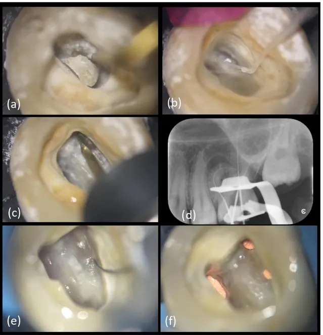 Figure 8. Main clinical steps of case 2. (a) Access cavity with US tips, (b) chamber irrigation with IrriFlex ® , (c) orifices 