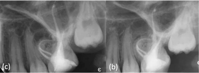 Figure 9. (a) Post-operative X-ray was taken. (b) At 6 months review the periapical X-ray showed a smaller radiolucent  area around the mesial buccal root