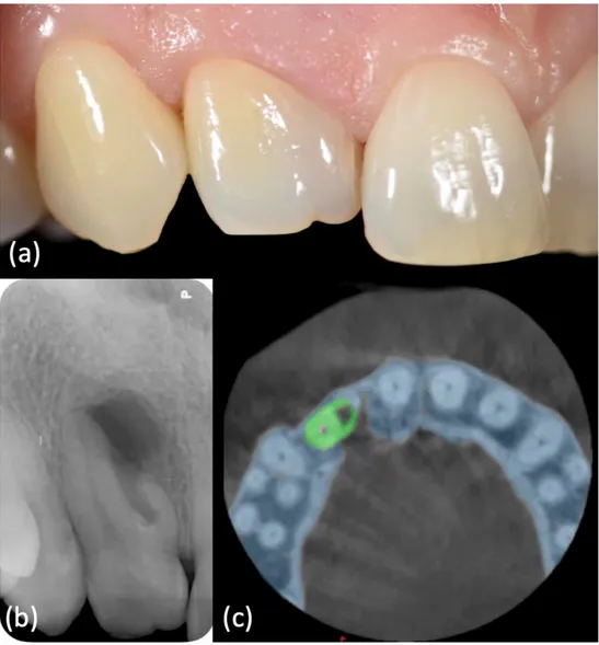 Figure 1. (a) Intraoral examination showed a wide crown of element 1.2, typical anatomy of a dens  invaginatus