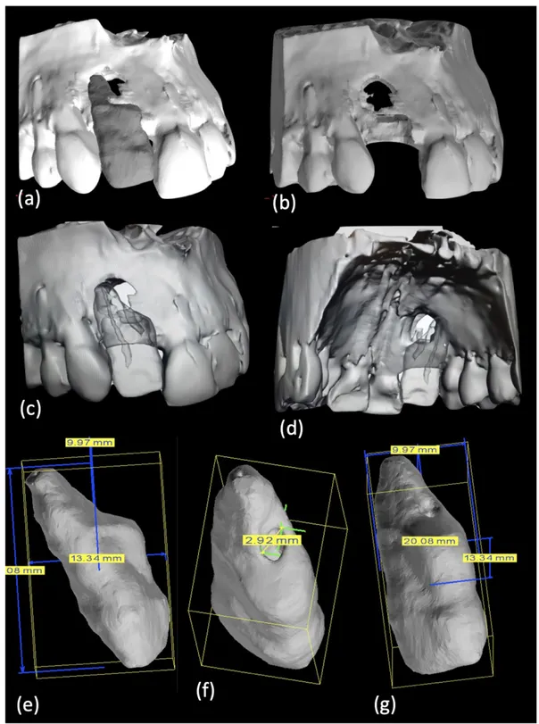 Figure 2. (a–d) An STL of bone structure with and without element 1.2 was produced and (e–g) dimensions of element 1.2  were achieved