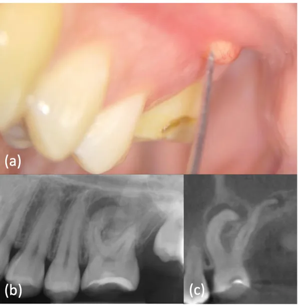 Figure 6. (a) Intraoral examination showed a lump on buccal side of element 2.6, which appeared not to be completely  erupted and with a carious lesion