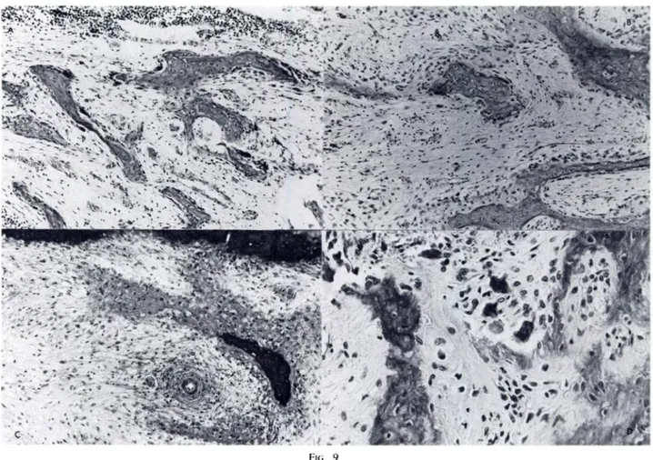Fig. 7-A: The periosteum is thickened. with multiple layers of collagen fibers and vessels on the outer surface