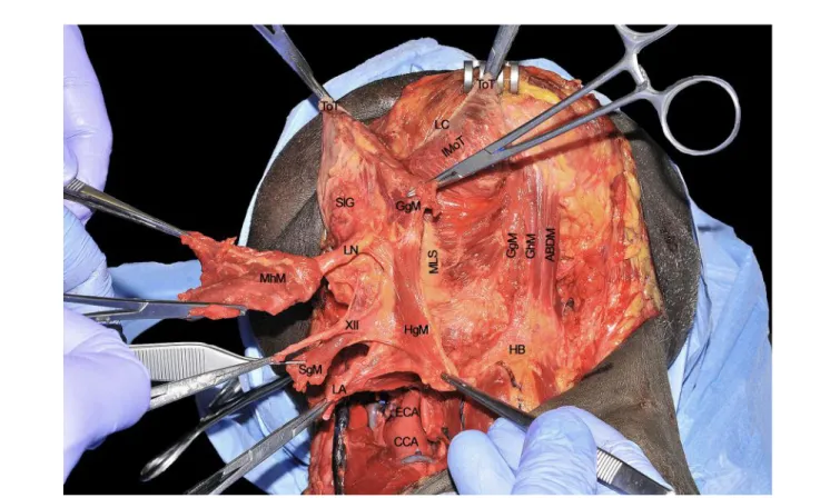 FIGURE 12 | ABDM, anterior belly of digastric muscle; CCA, common carotid artery; ECA; external carotid artery; HB, hyoid bone; HgM, hyglossus muscle; GgM, genioglossus muscle; GhM, geniohyoid muscle; IMoT, intrinsic muscle of tongue; LA, lingual artery; L