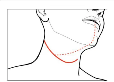 FIGURE 1 | Skin incisions for CS of the tongue and ﬂoor of mouth: the continuous line represents that usually followed in case of pull-through approach and unilateral neck dissection (while tracheostomy is performed via a separated caudal stab wound); dott