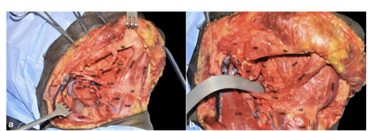 FIGURE 2 | (A, B) ABDM, anterior belly of digastric muscle; CCA, common carotid artery; ECA, external carotid artery; EJV, external jugular vein; FA, facial artery; GAN, great auricular nerve; HB, hyoid bone; HgM, hyoglossus muscle; ICA, internal carotid a