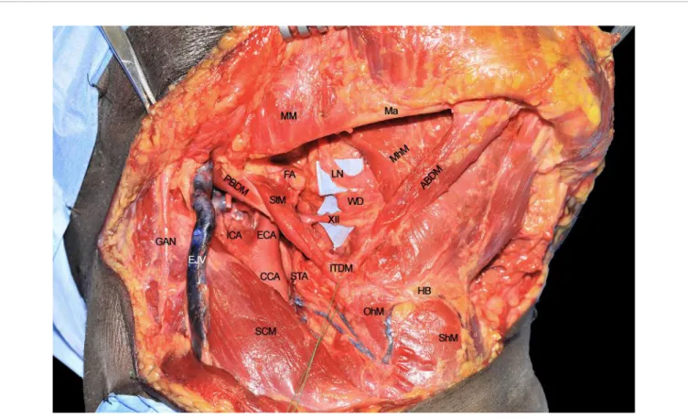 FIGURE 3 | ABDM, anterior belly of digastric muscle; CCA, common carotid artery; ECA, external carotid artery; EJV, external jugular vein; FA, facial artery; GAN, great auricular nerve; HB, hyoid bone; ICA, internal carotid artery; ITDM, intermediate tendo
