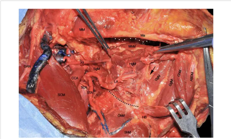 FIGURE 4 | ABDM, anterior belly of digastric muscle; CCA, common carotid artery; EJV, external jugular vein; GAN, great auricular nerve; GgM, genioglossus muscle; GhM, geniohyoid muscle; HB, hyoid bone; HgM, hyoglossus muscle; LA, lingual artery; Ma, mandi