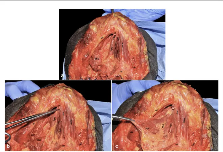 FIGURE 7 | (A –C) ABDM, anterior belly of digastric muscle; GgM, genioglossus muscle; GhM, geniohyoid muscle; GT, genial tubercle; HB, hyoid bone; Ma, mandible; MhM, mylohyoid muscle; MM, masseter muscle; MLS, median lingual septum; ShM, sternohyoid muscle