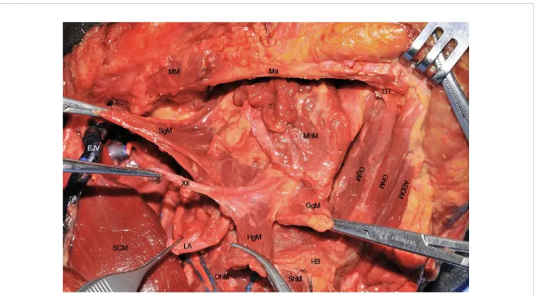 FIGURE 9 | ABDM, anterior belly of digastric muscle; EJV, external jugular vein; GgM, genioglossus muscle; GhM, geniohyoid muscle; GT, genial tubercle; HB, hyoid bone; HgM, hyoglossus muscle; LA, lingual artery; Ma, mandible; MhM, mylohyoid muscle; MM, mas