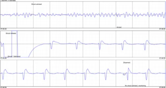 Fig.  1. ECG waveform of subject 12,999 in ventricular ﬁbrillation which returns to ROEA after the deﬁbrillation