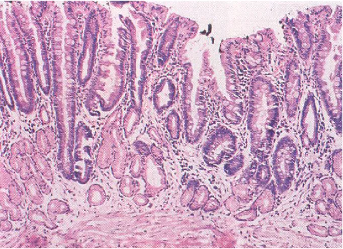 Fig. 1.6 Esofago di Barret: aspetto microscopico della mucosa. 