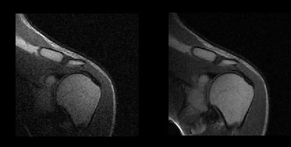 Fig. 4.2-Immagini di una spalla ottenute con due bobine separate (Bobina 1  e Bobina 2) 