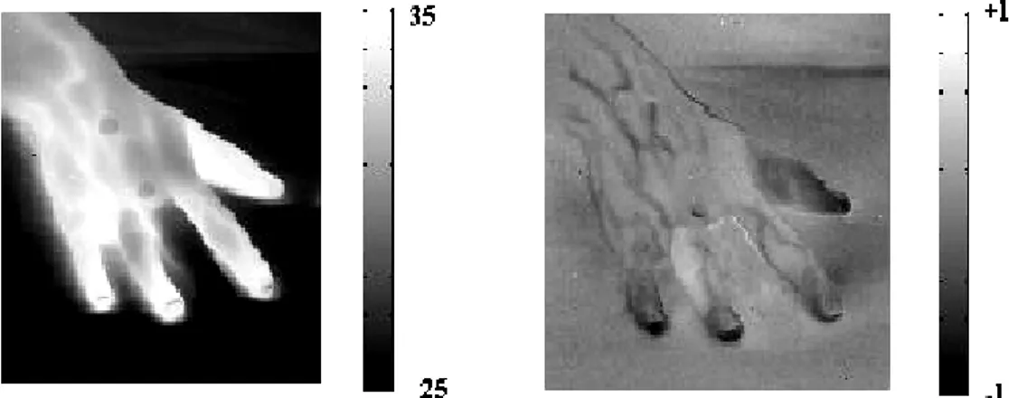 fig 2- 5    Imaging funzionale infrarosso della mano di soggetto affetto da disfunzione circolatoria (vasospasma  cronico dell'arteria digitale) 