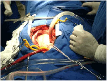 Fig 3- 1  Campo chirurgico nel corso di un intervento di rivascolarizzazione coronarica, dopo che è stata  praticata l’apertura del torace