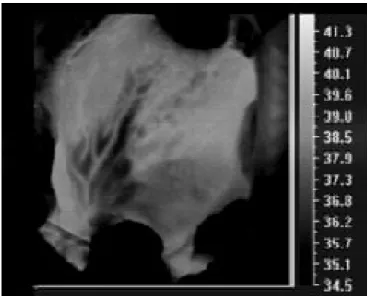 Fig 6- 1   Fotogramma del filmato di termografia acquisito nel corso di un intervento di cardiochirurgia, in cui è  visibile la distribuzione epicardica dei vasi coronarici