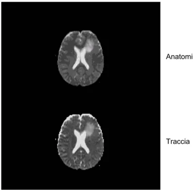 Figura 3.1: Immagine anatomica (pesata in T 2  ) e relativa mappa di traccia a bvalue = 1000 sec/mm 2 