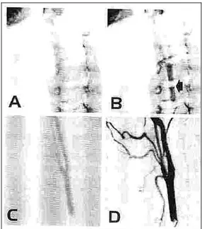 Figura 1.11  Procedimento angiografico digitale per sottrazione.  A: immagine di base utilizzata come maschera 