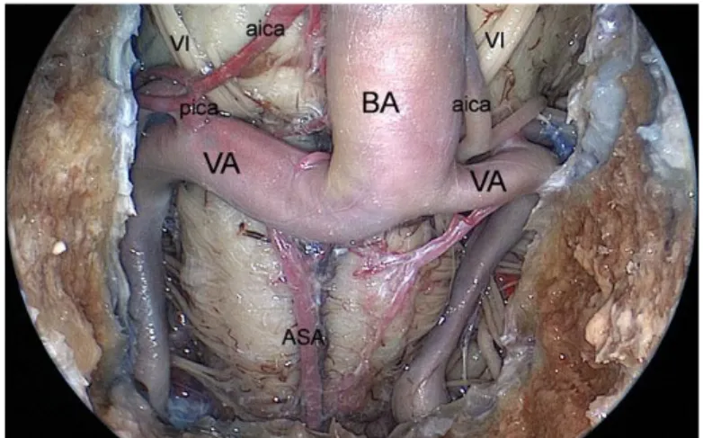 Figure  6:  Endoscopic  endonasal  view  of  the  superior  third  of  the  retroclival  area;  exposure  of  the  neurovascular  structures,  after  bone removal