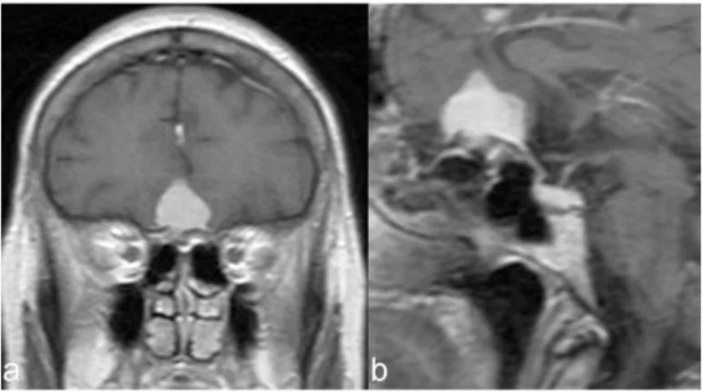 Figure  8:  Picture  showing  a  preoperative  MRI  scan  showing  the  case of a planum sphenoidale meningioma