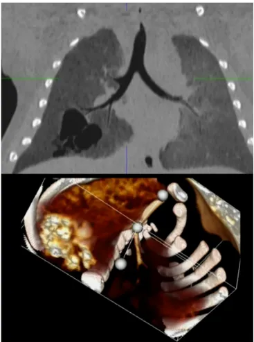 Fig. 11: femmina di 6 mesi con diagnosi prenatale di CPAM, confermata a 3 mesi da TC con mdc