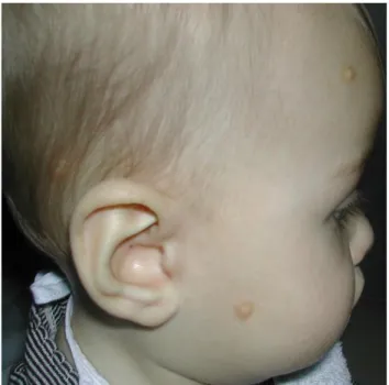 Figure 2. Mastocytomas of skin in child 
