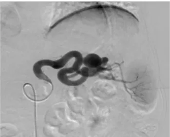 Figure 4. Complete aneurysm exclusion and patency of  the splenic artery 