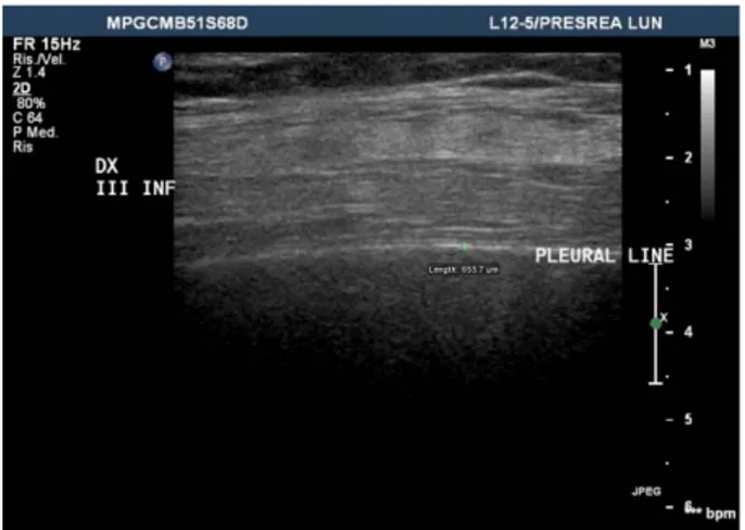 Fig 4: Lung Ultrasound (LUS): High frequency transducer (12 Mhz)  linear  probe  positioned  on  anterior  right  axillary  line  (middle  lobe)