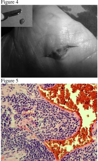 Figure 5: Histological findings: blood vessels  surrounded by a proliferation of small round  cells with dark nuclei in a myxoid stroma