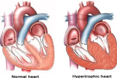 Figure 5: Hypertrophic Cardiomyopathy and Heart Failure. Hypertrophy are 