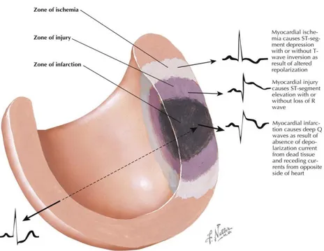 Figure 6: Ischemic injury, the principal cause of death in the world. [Netter F et al., 