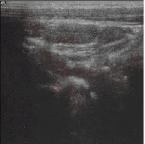 Fig. 3. Clinical case 3. Ultrasound image of a nodule at the level  of  the  right  thyroid  lobe  of  21x13  mm,  with  internal  calcifications