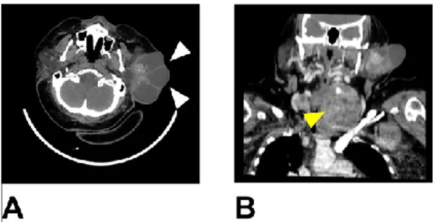 Figure  2:  Intraoperative  image  showing  a  capsulated,  solid  and  cystic mass in the superficial lobe  of the left parotid gland