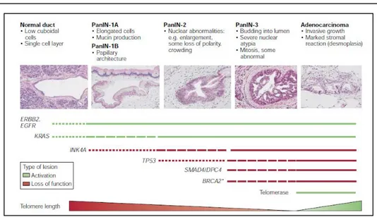 Figure 2.3: Genetic progression model of pancreatic adenocarcinoma [17]  The  second  major  precursor  lesion  to  be  identified  in  the  pancreas  was the intraductal papillary mucinous neoplasm (IPMN)