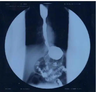 Fig 2. Image of the LES one month after the surgery 