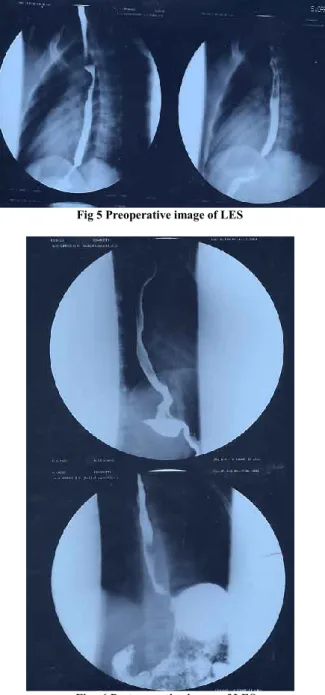 Fig 4 Post-operative image of  LES 