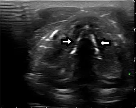 Fig. 1 – Normal vocal cords