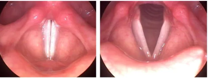 Fig. 2 - Normal vocal cords